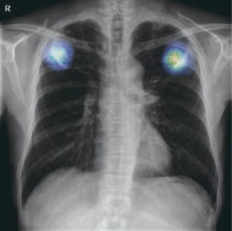 X-ray based tuberculosis scoring and monitoring solution 