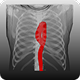 Aortic Diameter & Agatston Score